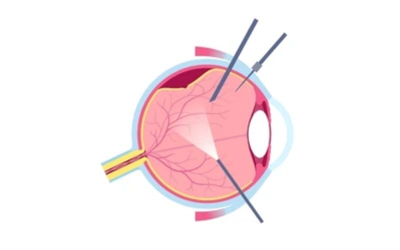 Macular Hole & Epiretinal Membrane Surgeries