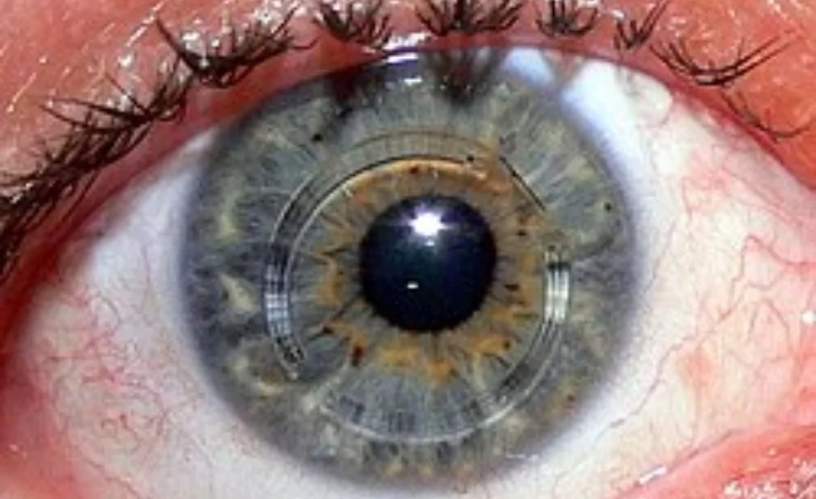 Intracorneal Ring Segments (ICRS)