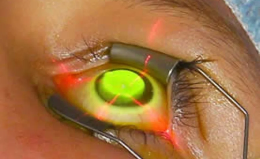 Corneal Collagen Cross-Linking (CXL)