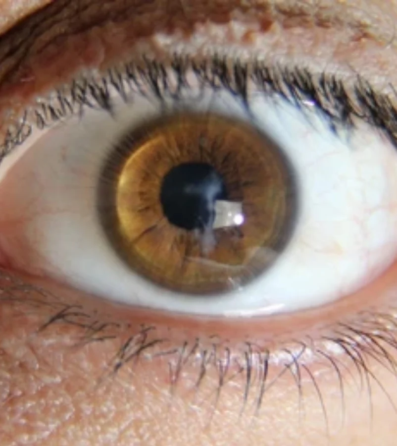 Advanced Keratoplasty